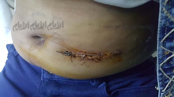 مكان زرع لحم الإصبع في البطن مكان زرع لحم الإصبع في البطن